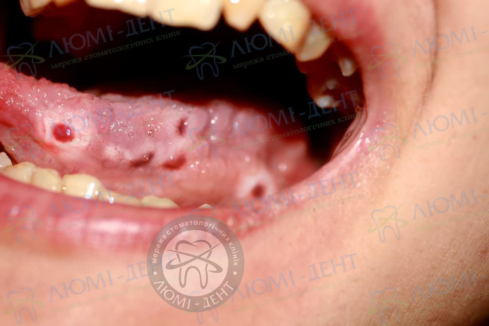 Герпетичний стоматит на язиці фото Люмі-Дент