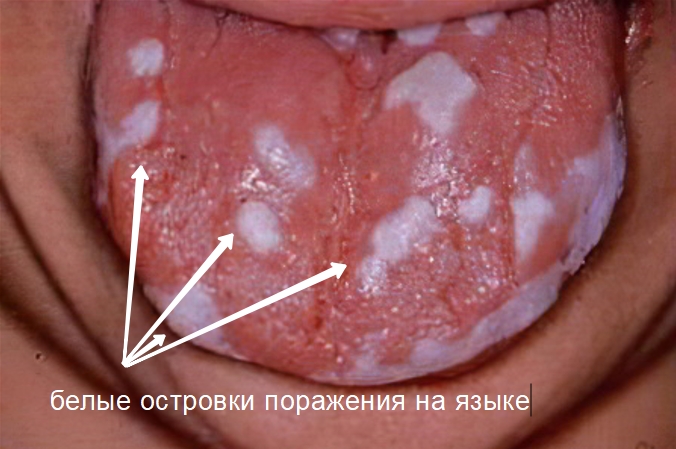 Кандидозный стоматит у взрослого фото Люми-Дент
