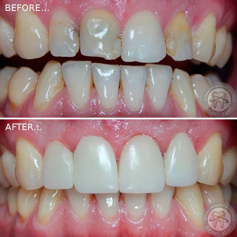 teeth restoration