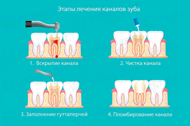Этапы лечения каналов зуба Этапы лечения каналов зуба