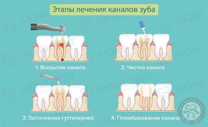 Чистка каналов зуба больно или нет фото Люми-Дент