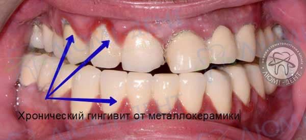 Металлокерамика зубов Киев фото Люми-Дент