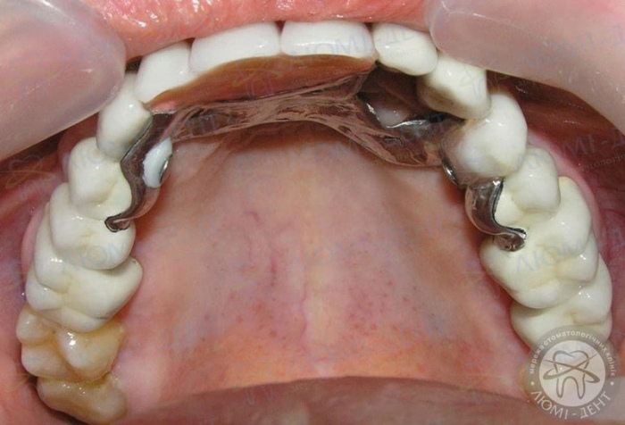 Бюгельный протез во рту фото Люми-Дент