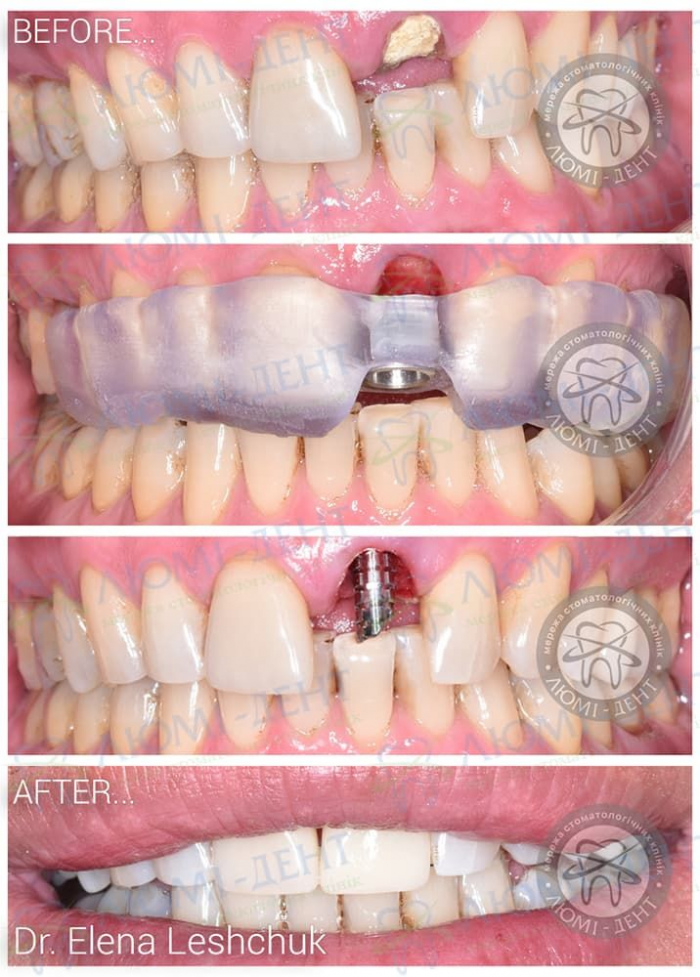 Недостатки экспресс имплантации зубов фото ЛюмиДент