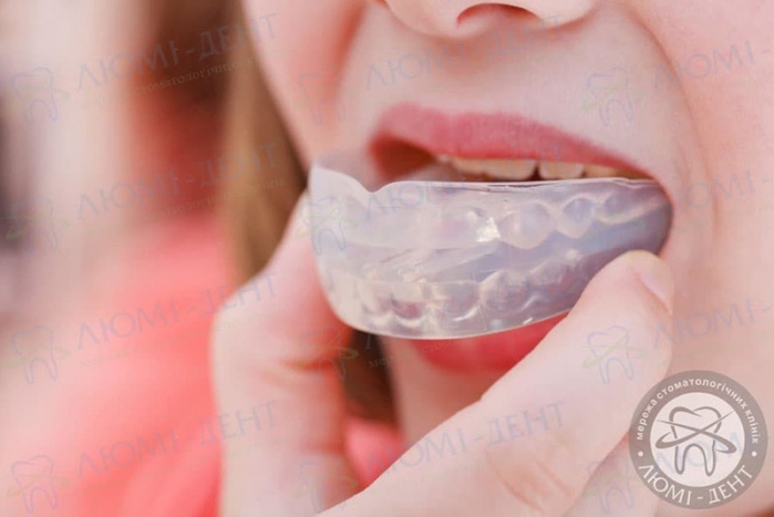 Вирівнювання зубів без брекетів фото Люмі-Дент
