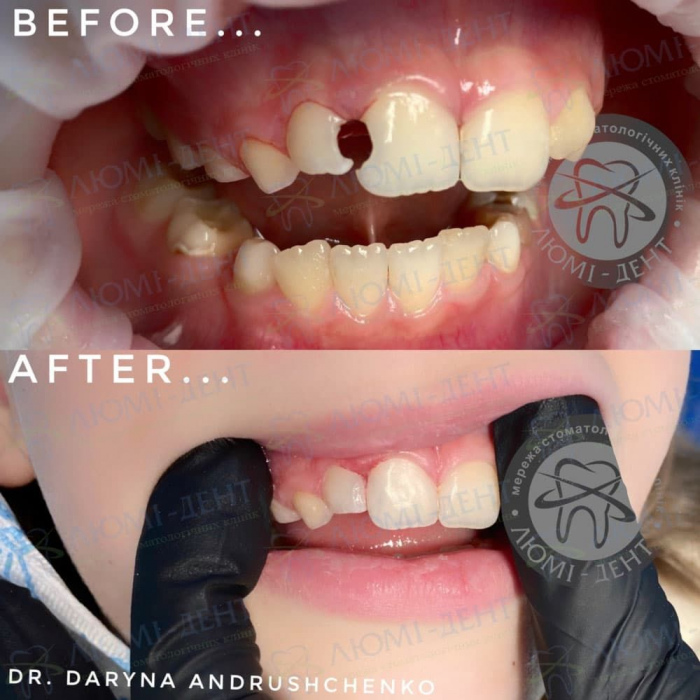 Лечение и реставрация молочных зубов фото Люми-Дент
