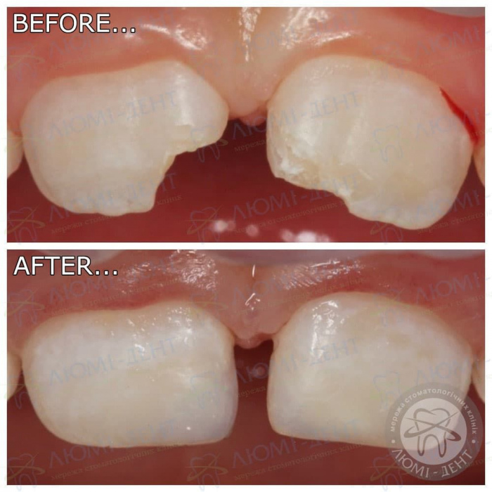 Реставрация молочных зубов фото Люми-Дент