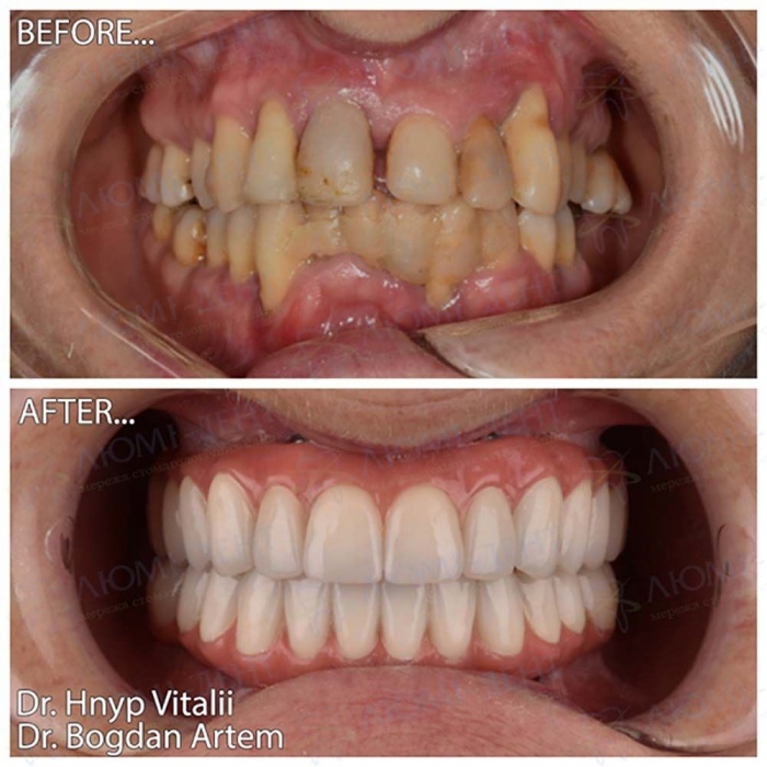 Пример работы по установке имплантов пациенту клиники Люми-Дент Имплант зуба фото Люми-Дент
