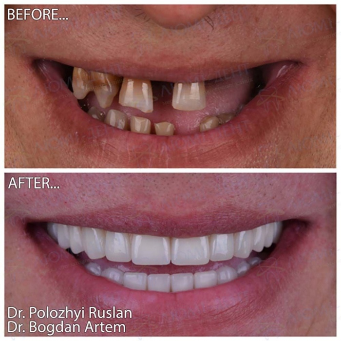 Пример работы по имплантации зубов врача нашей клиники Импланты зубов цена фото Люми-Дент