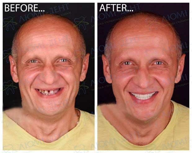 Протезирование челюстей в Люми-Дент Цена зубного импланта фото Люми-Дент