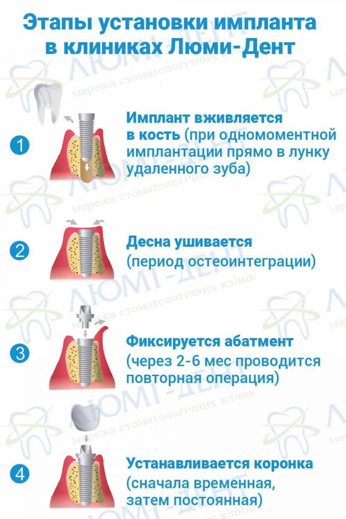 Этапы установки имплантов зубов в Люми-Дент Зубные импланты цена фото Люми-Дент