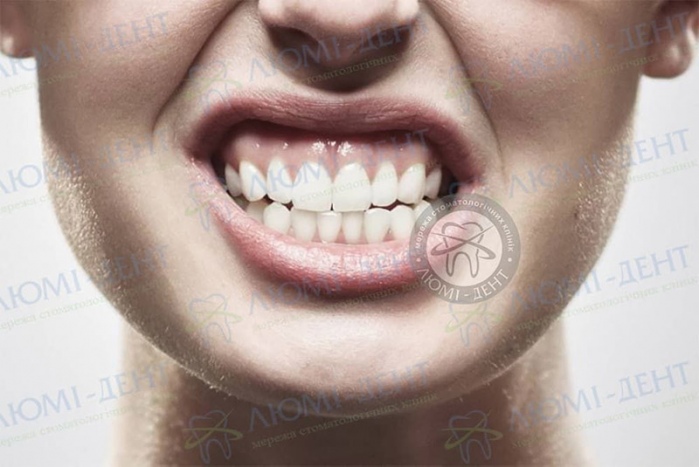Як позбутися скреготу зубами фото Люмі-Дент