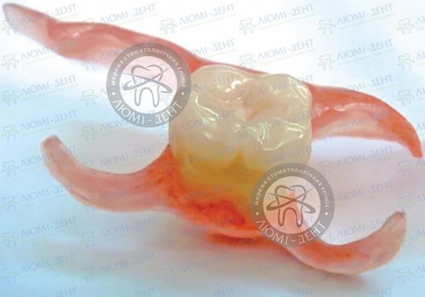 Съемный Протез на один зуб фото Люми-Дент