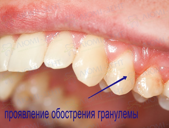 Клиническое проявление обострения гранулемы у верхушки корня зуба Клиническое проявление обострения гранулемы у верхушки корня зуба