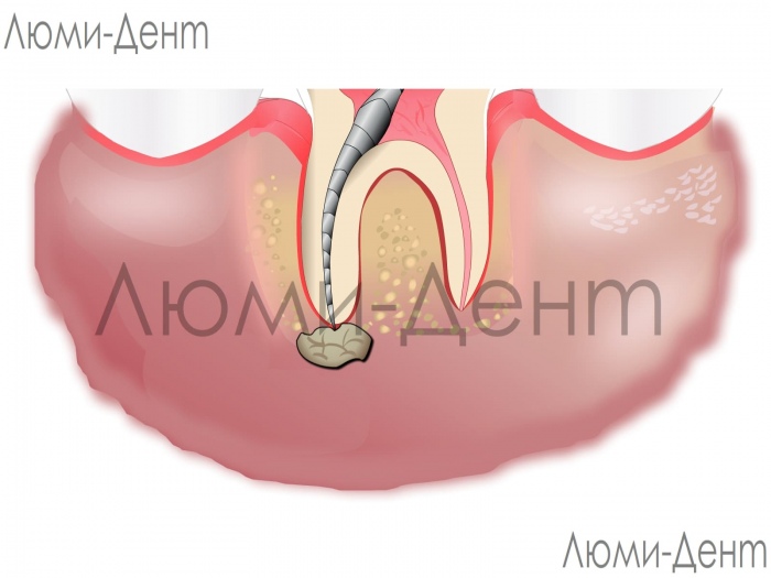 Лечение гранулемы зуба фото Люми-Дент