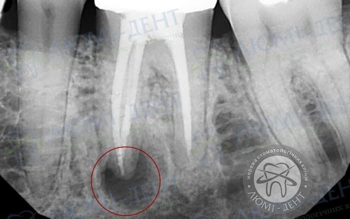 Рентген гранулемы зуба фото Люми-Дент