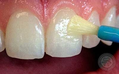 Укрепление эмали зубов имплантация фото Люми-Дент