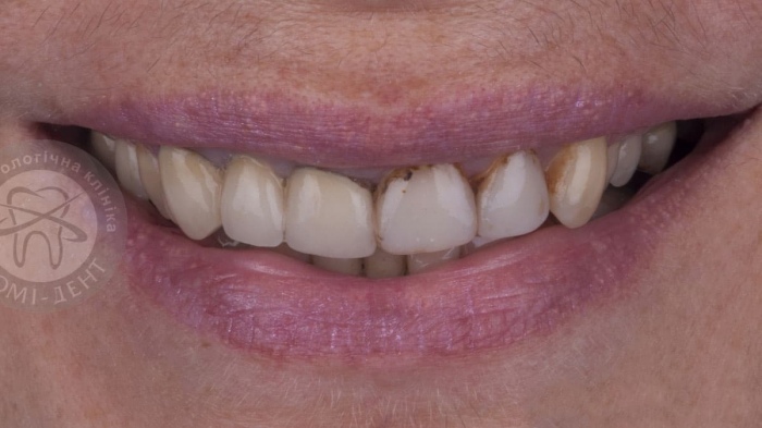 Восстановление зубной эмали зубов лечение фото Люми-Дент