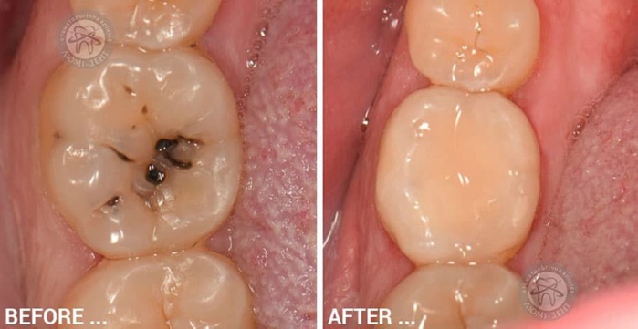 Зубной Кариес лечение фото Люми-Дент
