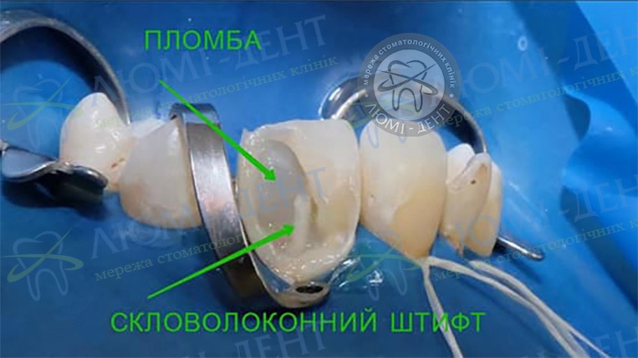 Відновлення зуба фото Люмі-Дент