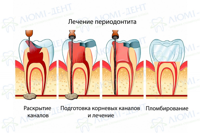 Как происходит лечение периодонтита Лечение периодонтита фото Люми-Дент