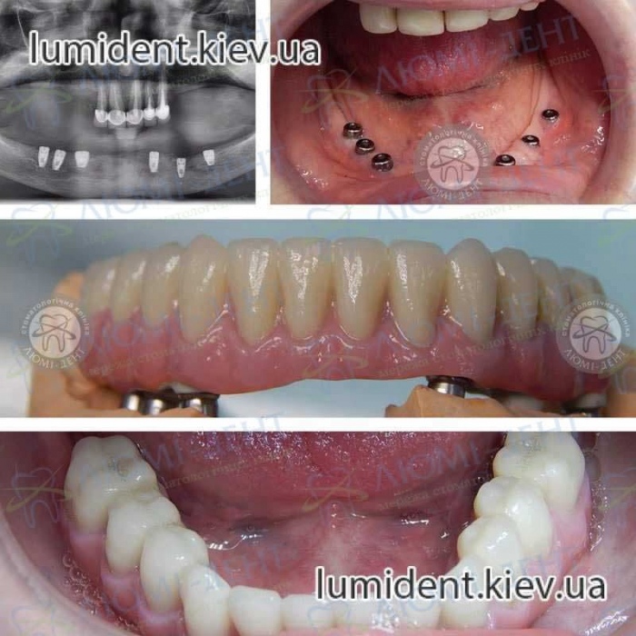Несъемные зубные протезы на имплантах фото Люми-Дент