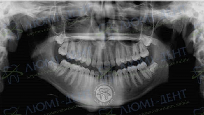 Диастема передних зубов фото Люми-Дент