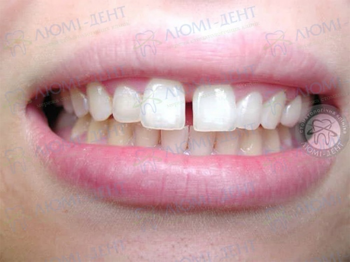 Диастема щель между зубам фото Люми-Дент