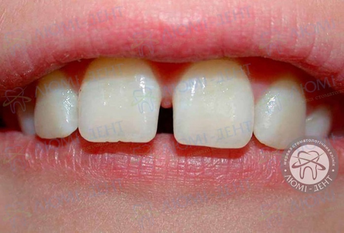 Диастема зубов у детей причины фото Люми-Дент