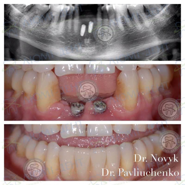 Имплантация зубов при диастеме фото Люми-Дент