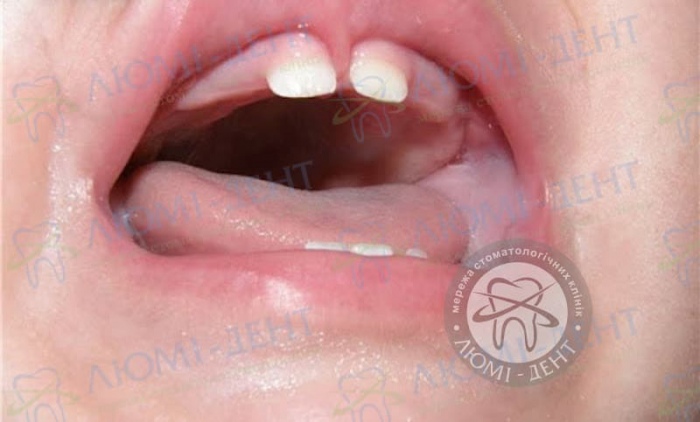 Хирургическая пластика уздечки губ при диастеме фото Люми-Дент