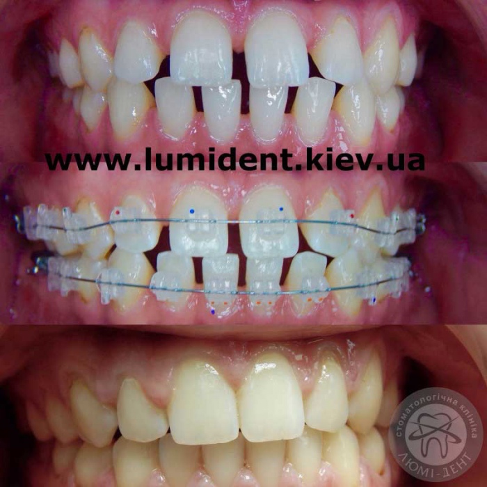 Фиксация шатающегося зуба в клинике фото киев Люми-Дент