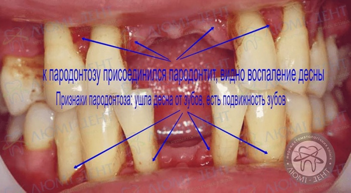 Подвижность зубов фото Люми-Дент