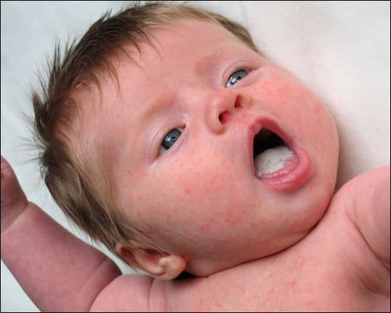 Стоматит у младенца фото Люми-Дент