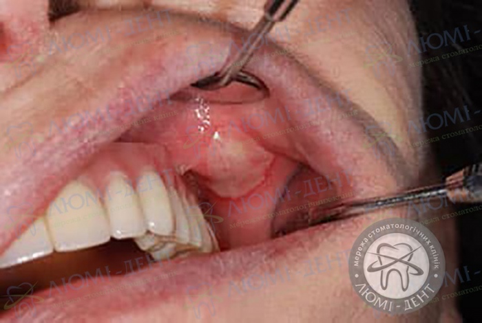 Инфекционный стоматит во рту у взрослых фото Люми-Дент