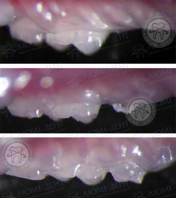 вирощування нових зубів фото Люмі-Дент