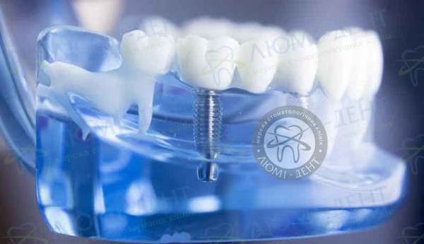 вирощування зубів клініки фото Люмі-Дент