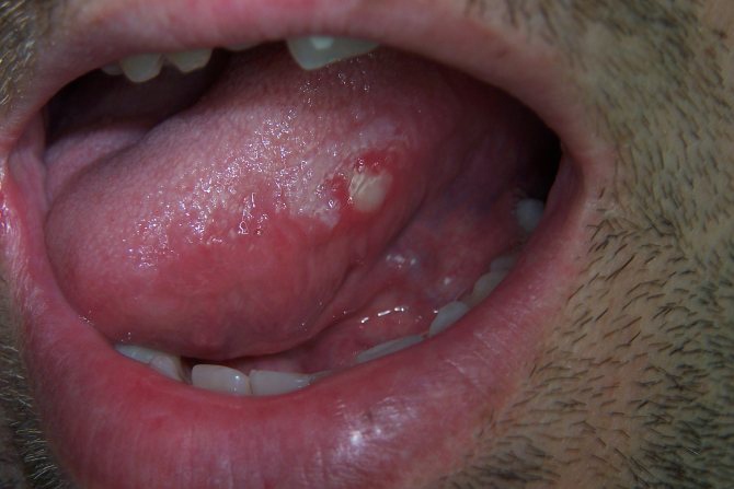 Чим лікувати рани в роті фото Люмі-Дент