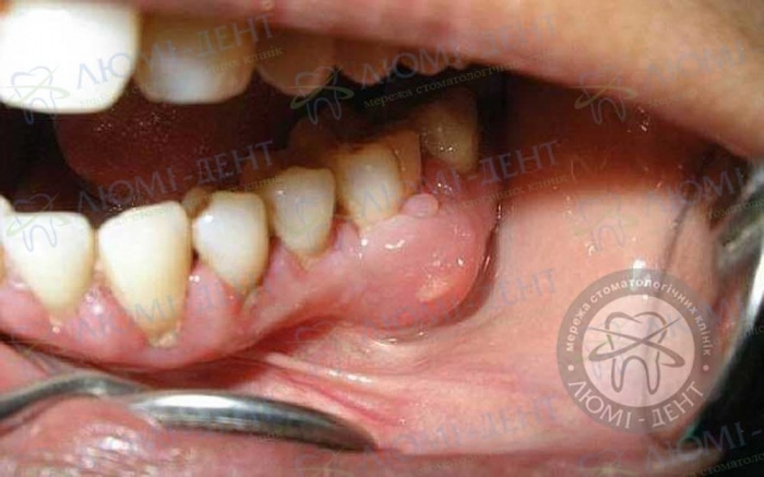 Одонтогенное воспаление надкостницы челюсти фото Люми-Дент