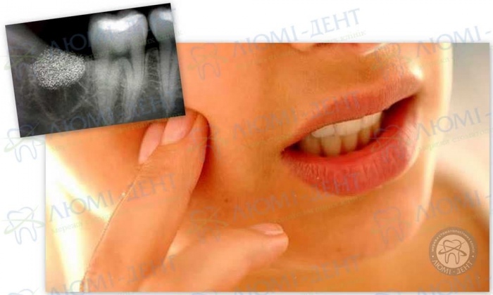 Основные причины развития периостита челюсти фото Люми-Дент