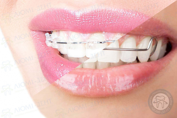 зубні скоби фото ЛюміДент