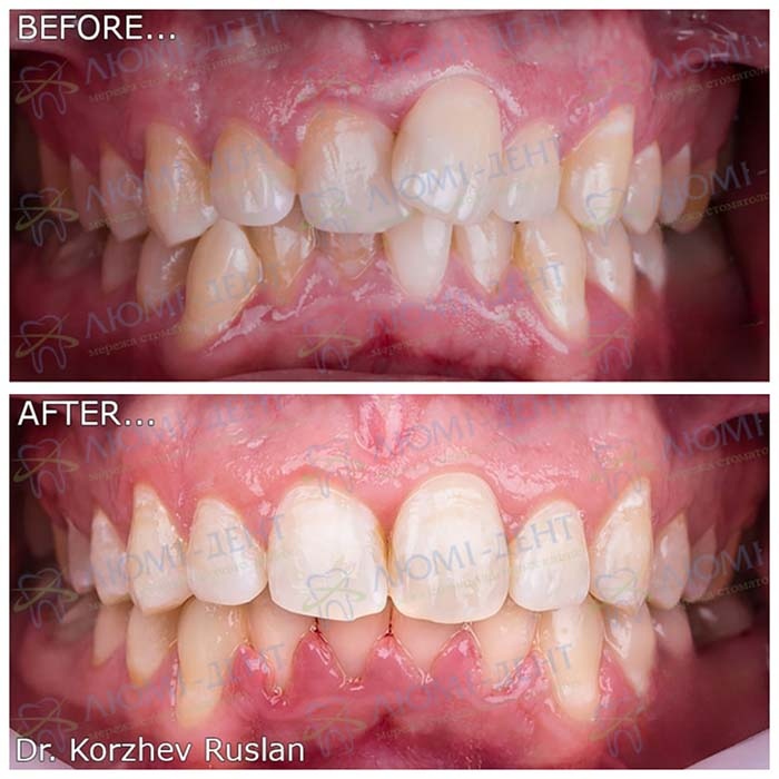 Результат исправления прикуса элайнерами Брекеты Киев фото Люми-Дент