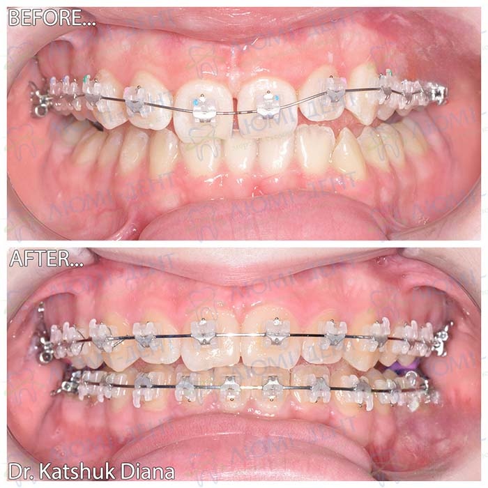 Пример установки эстетических брекетов на зубы Брекеты цена Киев фото Люми-Дент