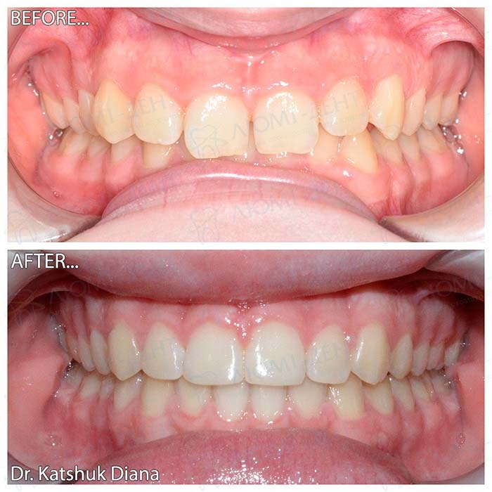 До и после исправления прикуса брекетами в Люми-Дент Поставить брекеты цена фото Люми-Дент