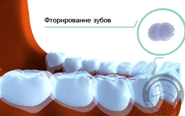 Реминерализация зубов фото Люми-Дент