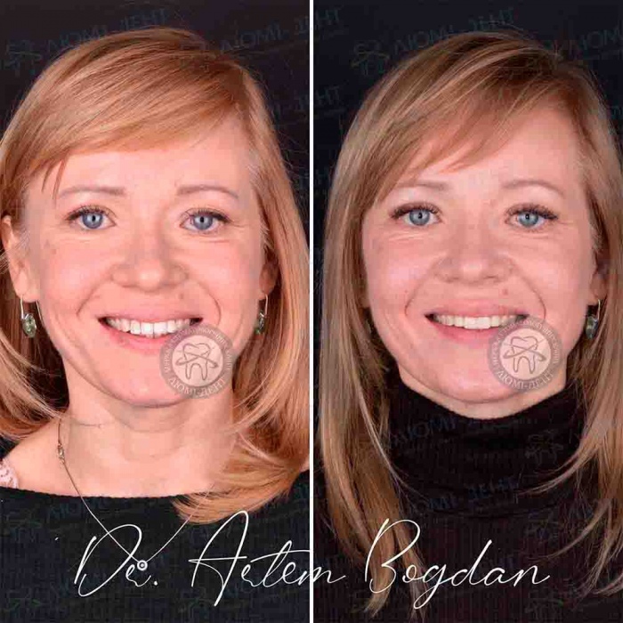 Фото с нашим пациентом  Гарантия на имплантацию фото Люми-Дент