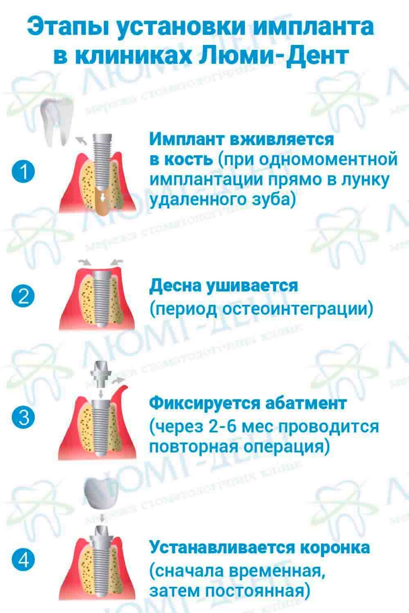 Этапы установки имплантов зубов в Люми-Дент  отторжение импланта гарантия фото Люми-Дент