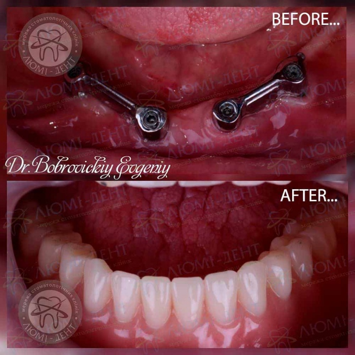 Пример протезирования на зубных имплантах в клинике Люми-Дент Отторжение импланта зуба отторгся фото Люми-Дент