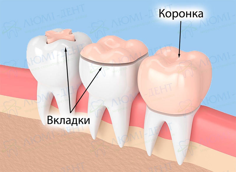 Разница между вкладками и коронками Керамические коронки Люми-Дент