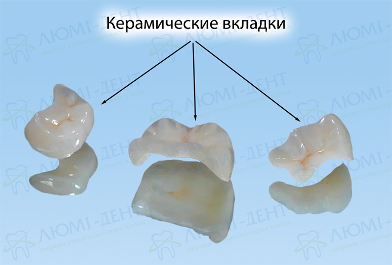 Фото керамических вкладок Керамические вкладки на зубы фото Люми-Дент